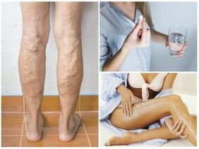 Varices sur les jambes et les méthodes de traitement