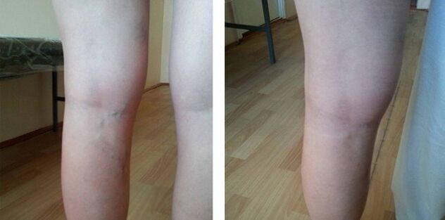Varices sur les jambes