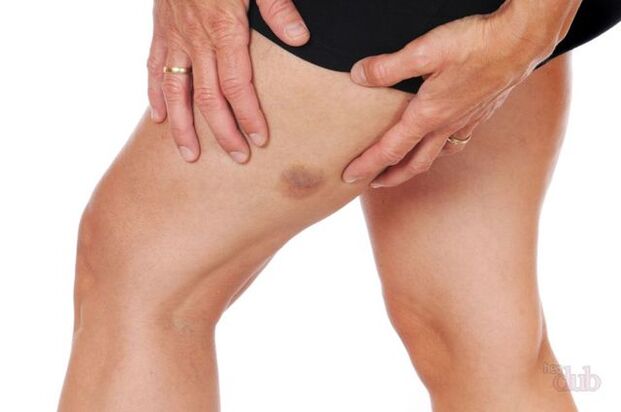 quand une veine éclate